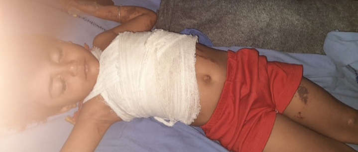 সম্পত্তির বিবাদে শিশুকন্যার গায়ে অ্যাসিড ছুঁড়ল দাদু-দিদা 